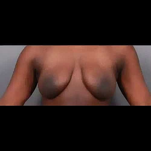 Breast Lift Before & After