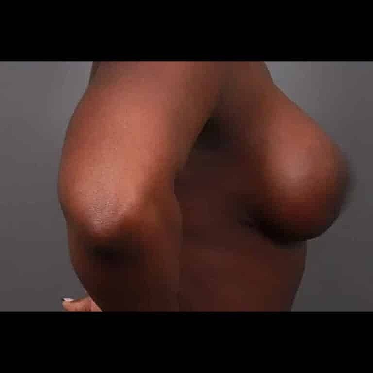 Breast Lift Before & After