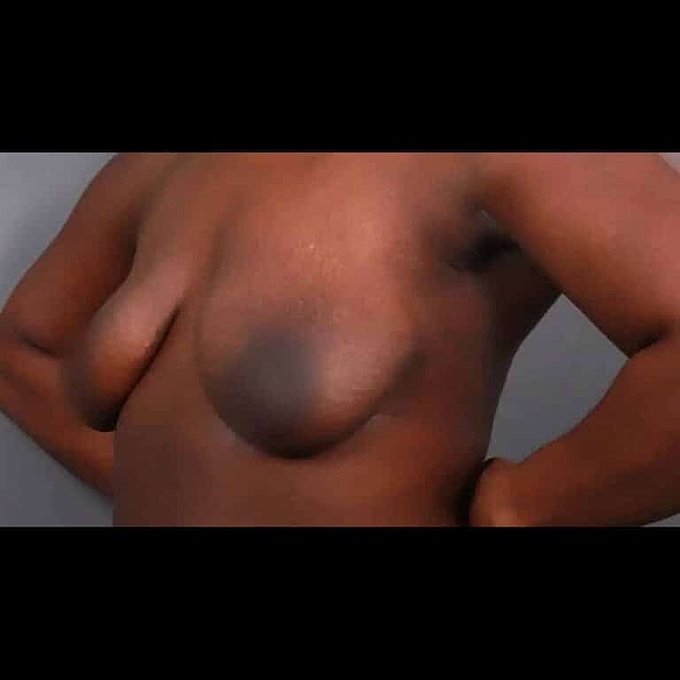 Breast Lift Before & After