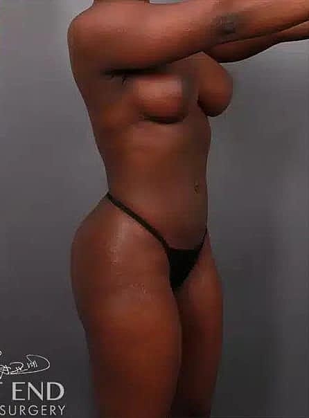 Breast Lift Before & After