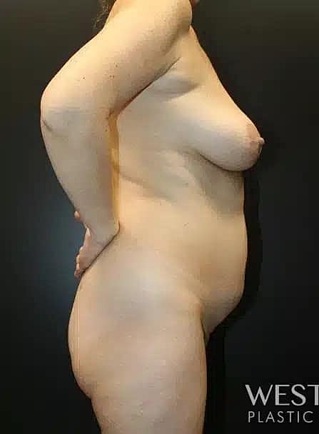 Breast Lift Before & After