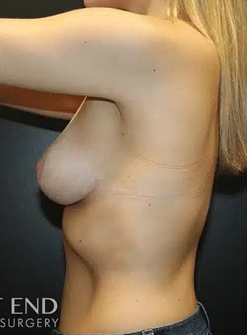 Breast Lift Before & After