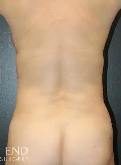 Breast Lift Before & After