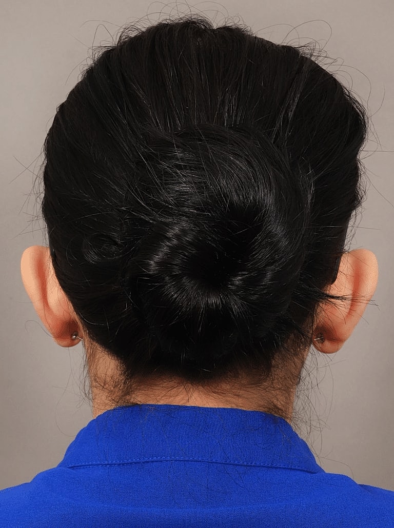 Otoplasty Before & After