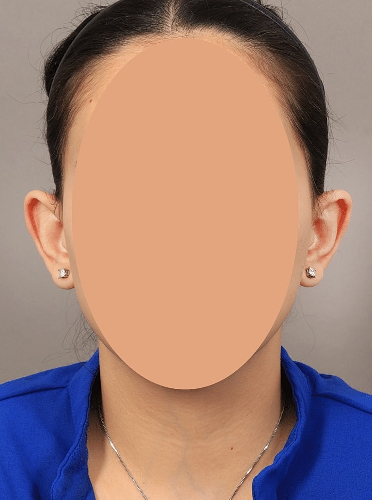 Otoplasty Before & After