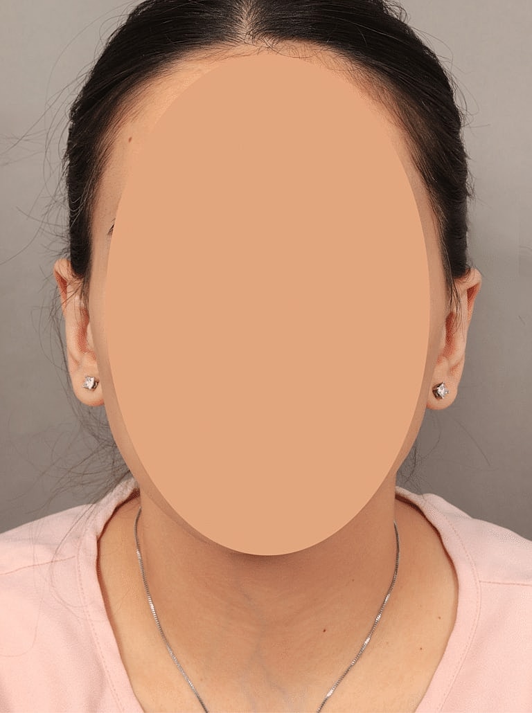 Otoplasty Before & After