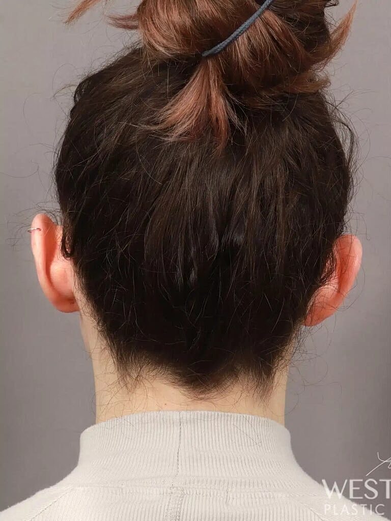 Otoplasty Before & After