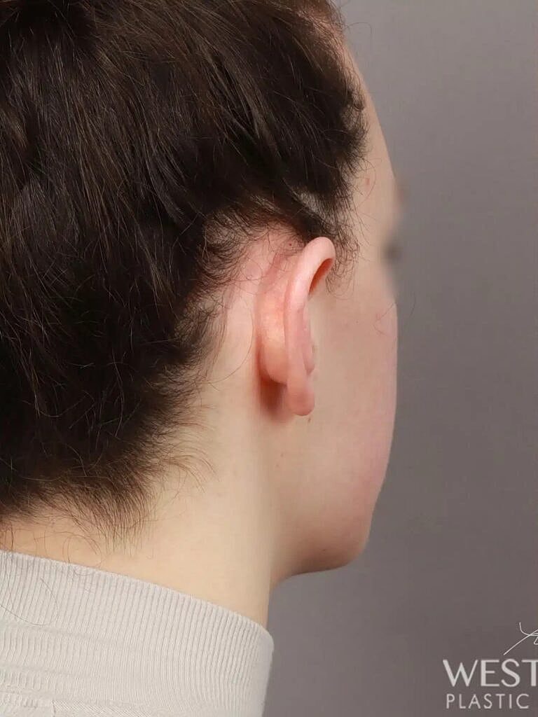 Otoplasty Before & After