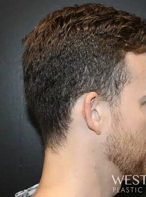 Otoplasty Before & After