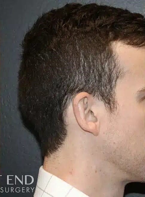 Otoplasty Before & After