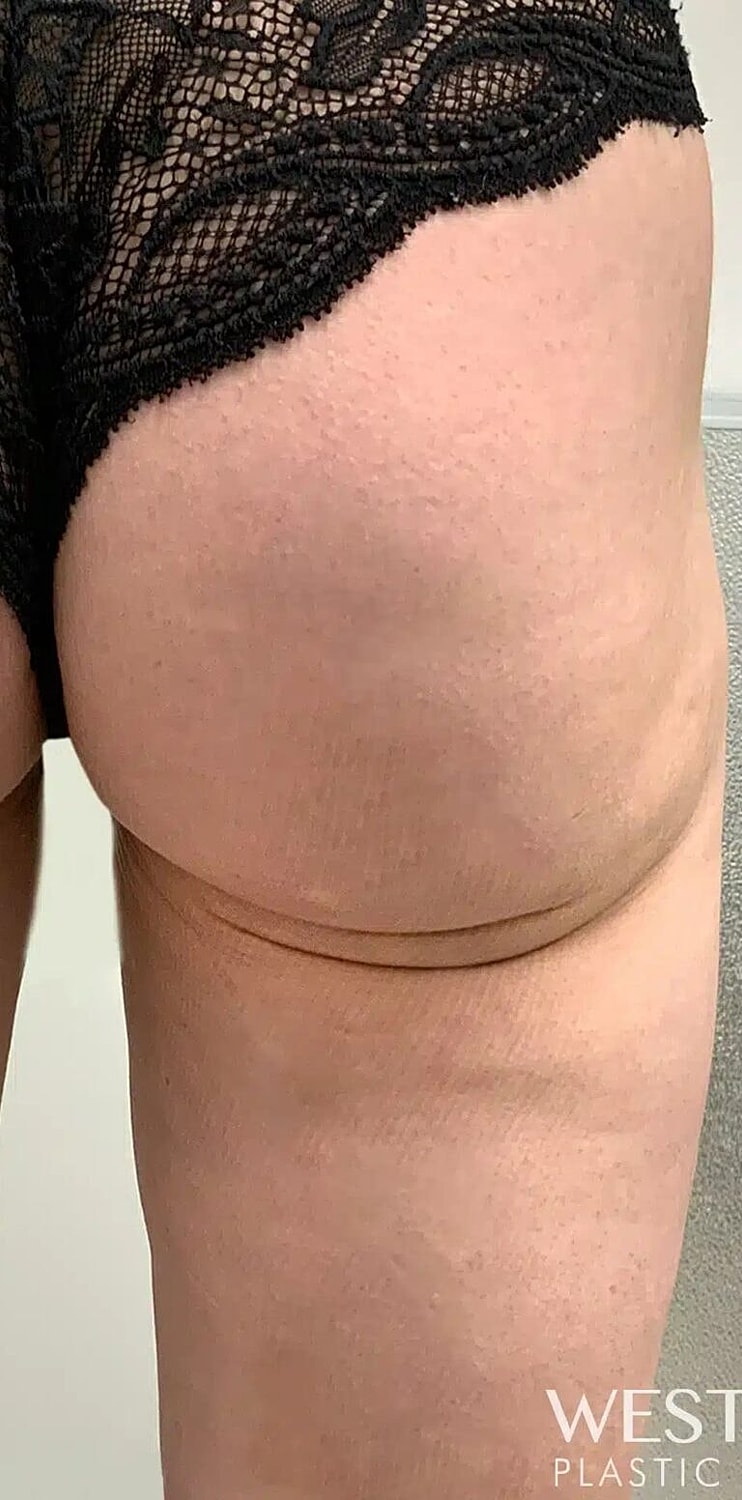 Kybella Before & After