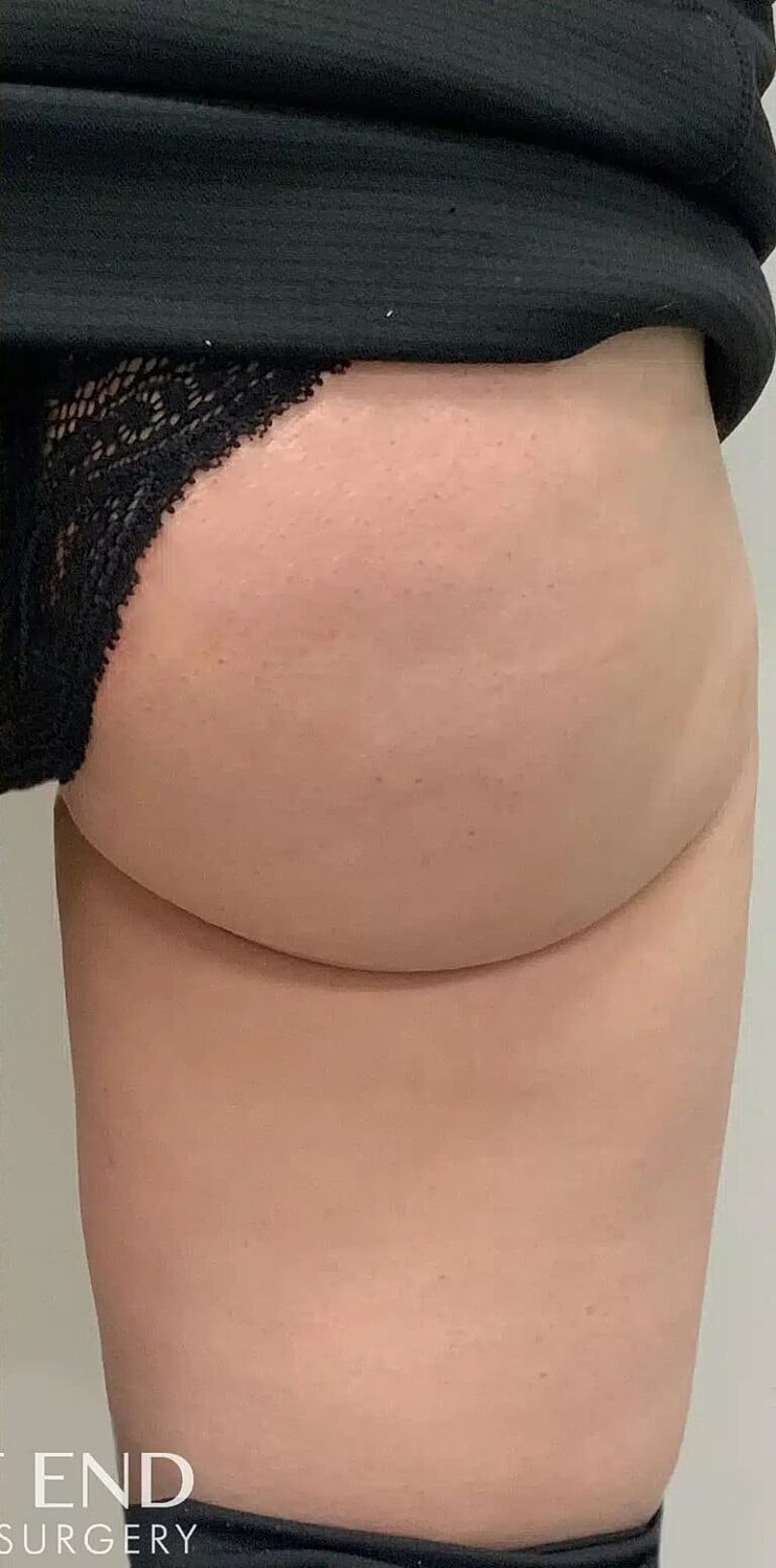 Kybella Before & After