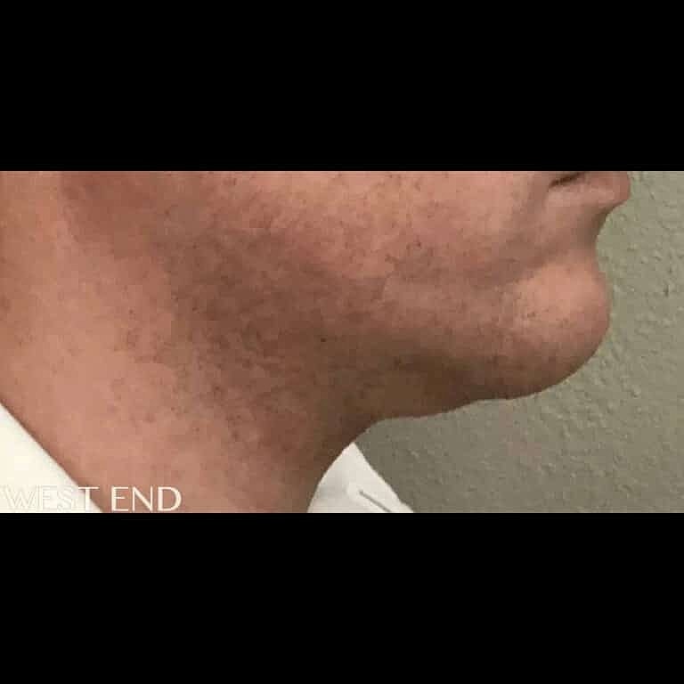 Kybella Before & After