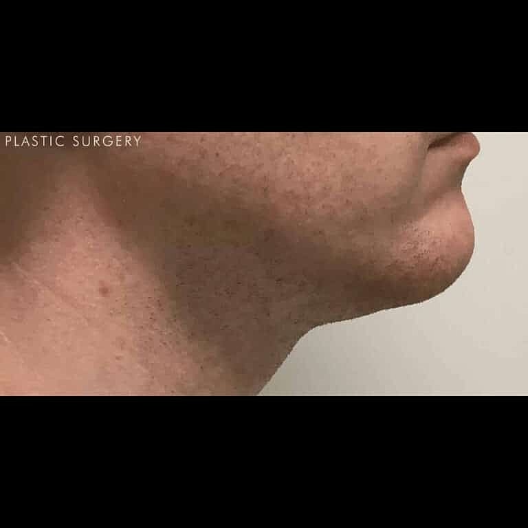 Kybella Before & After