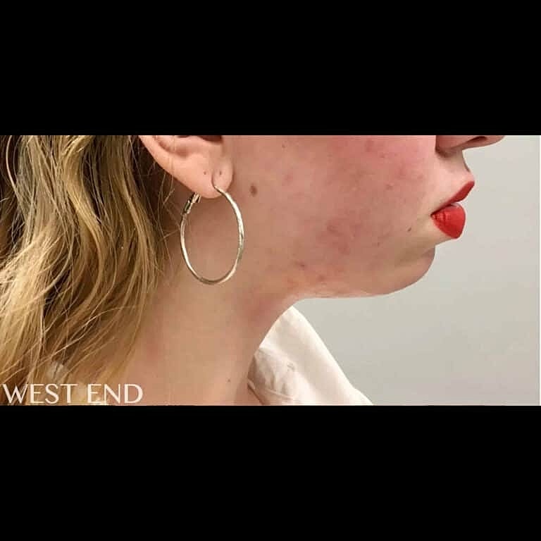 Kybella Before & After