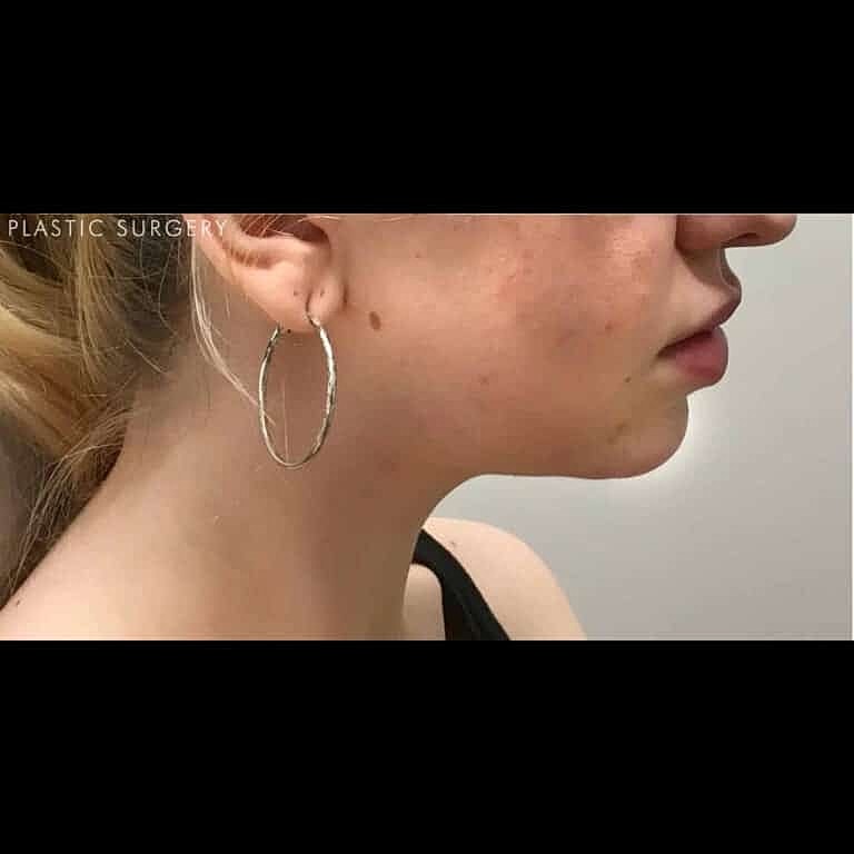 Kybella Before & After