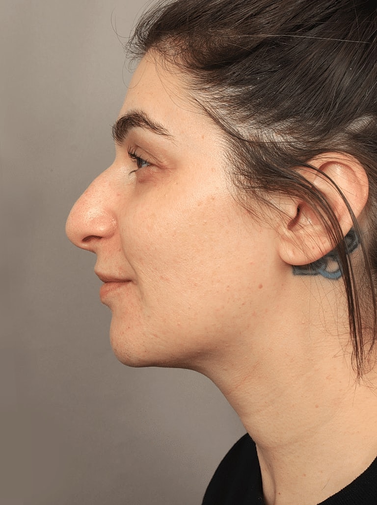 Restylane Before & After