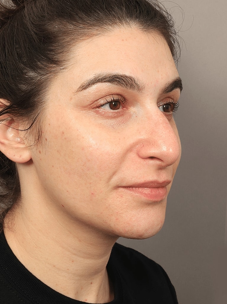 Restylane Before & After