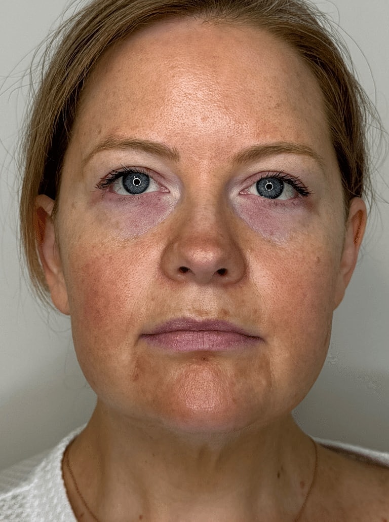 Restylane Before & After