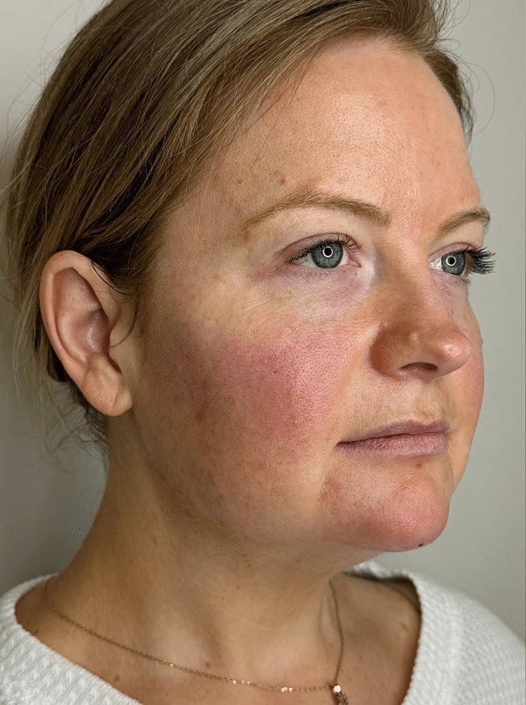 Restylane Before & After