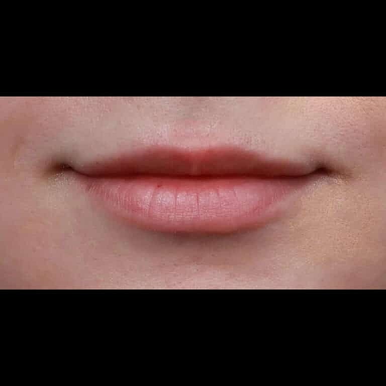 Restylane Before & After