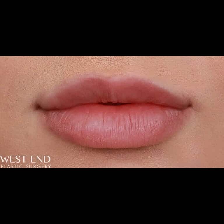 Restylane Before & After