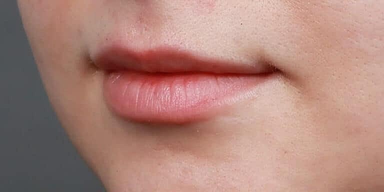 Restylane Before & After