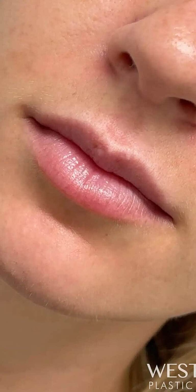 Restylane Before & After