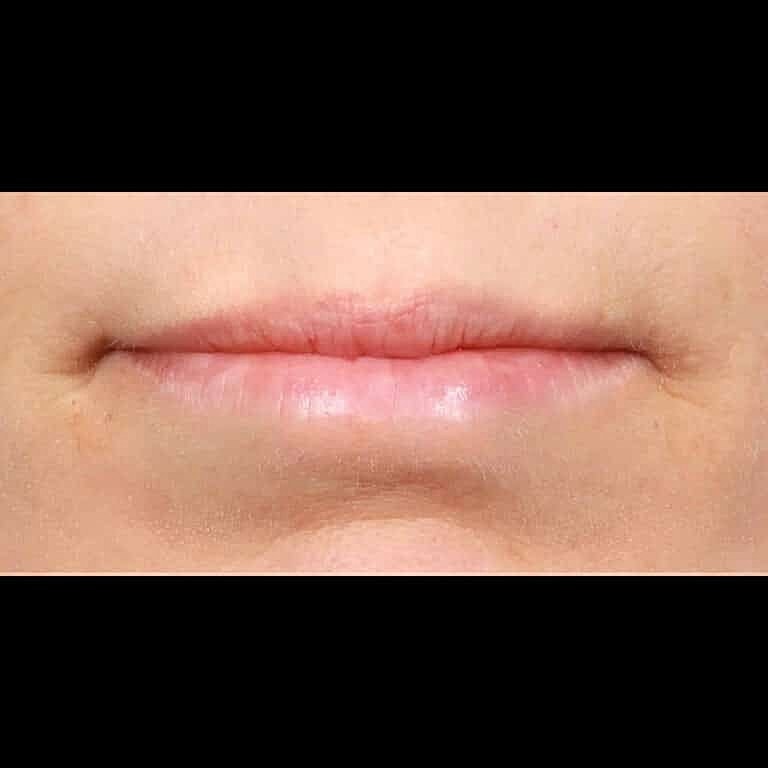 Restylane Before & After