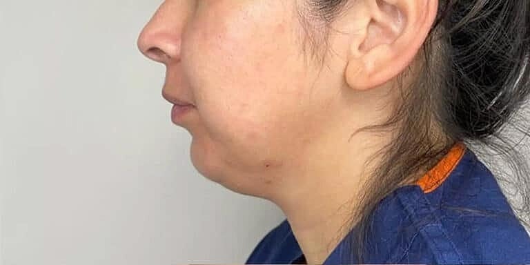 Restylane Before & After