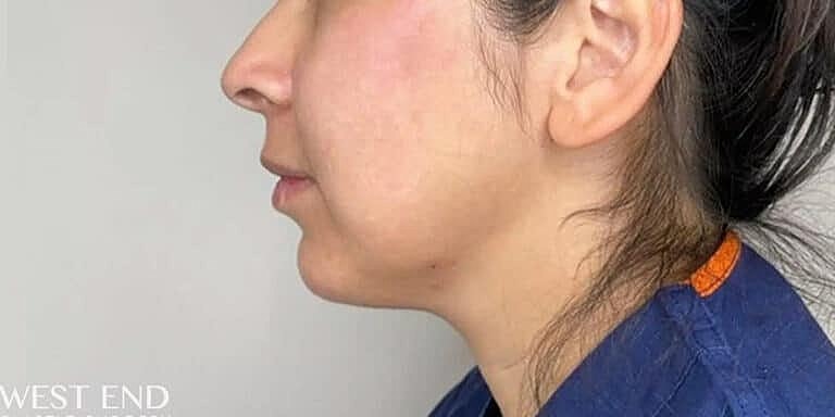 Restylane Before & After