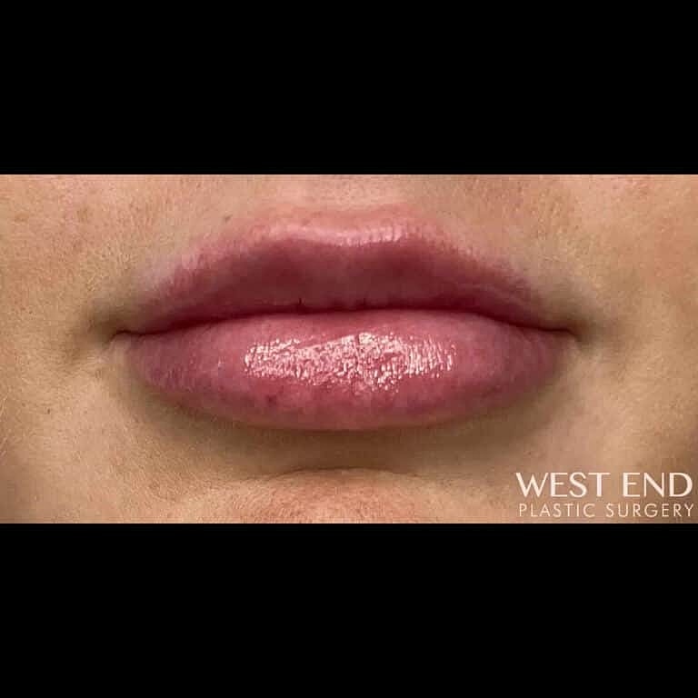 Restylane Before & After