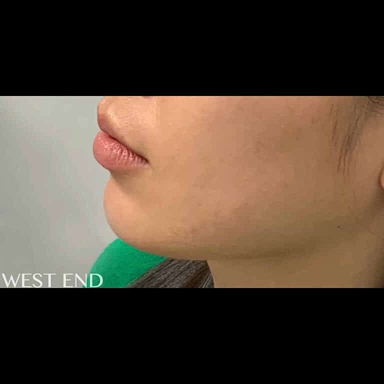 Restylane Before & After