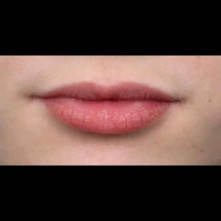 Restylane Before & After