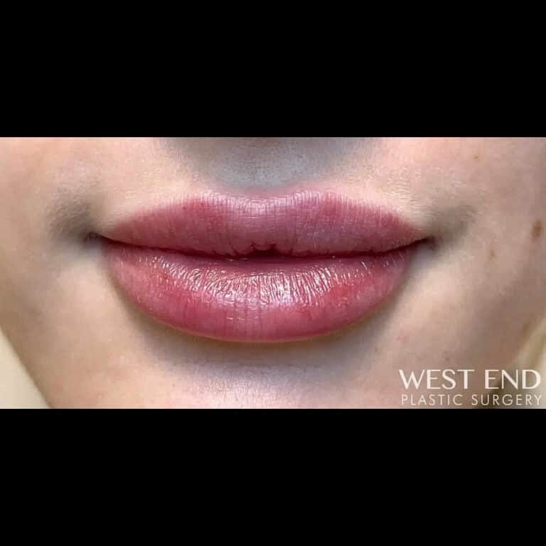 Restylane Before & After