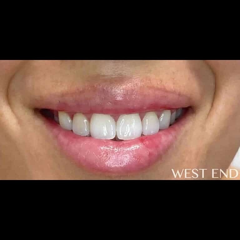 Restylane Before & After