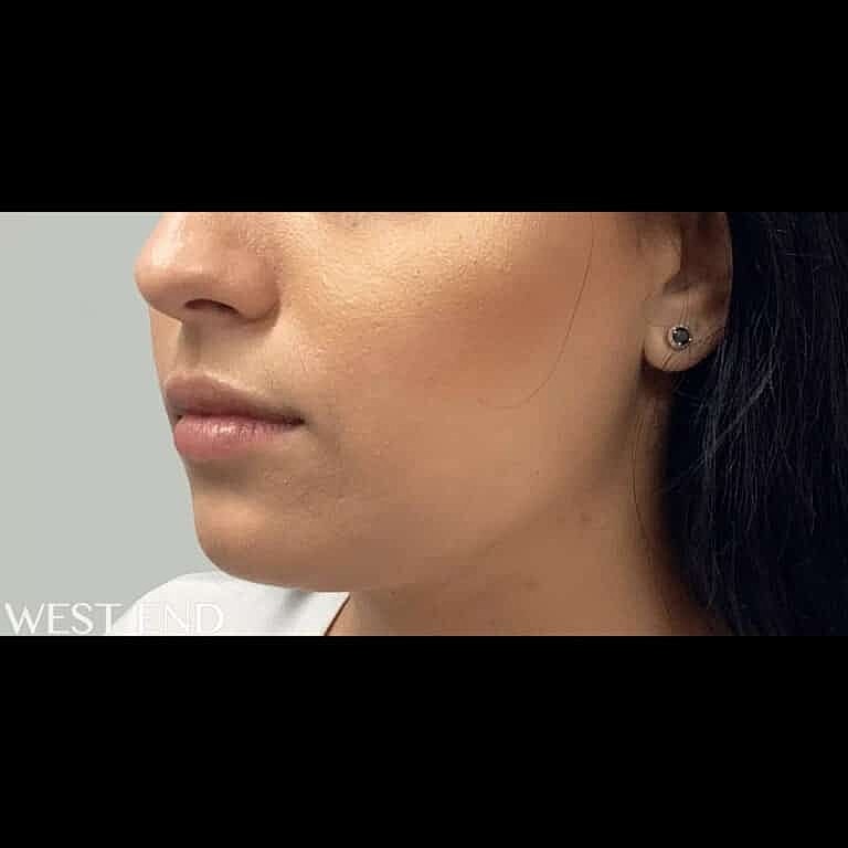 Restylane Before & After