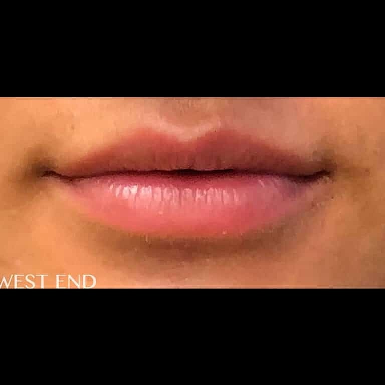 Restylane Before & After