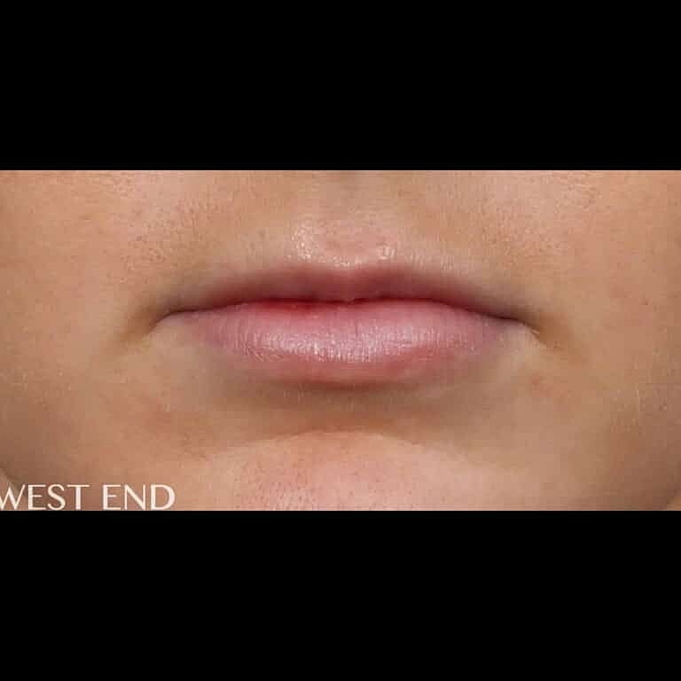 Restylane Before & After