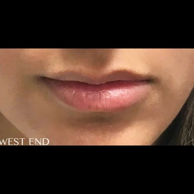 Restylane Before & After