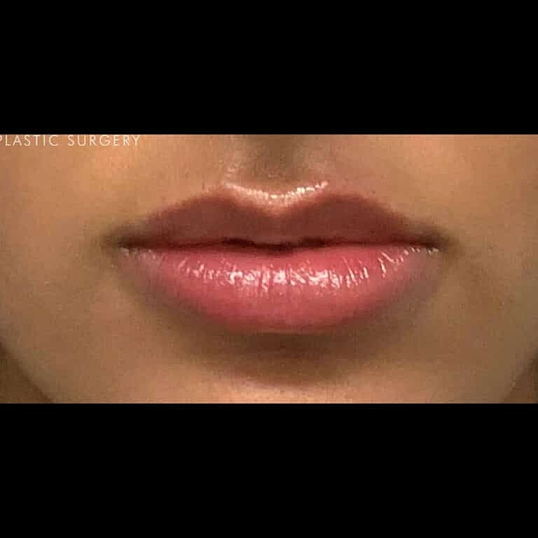 Restylane Before & After