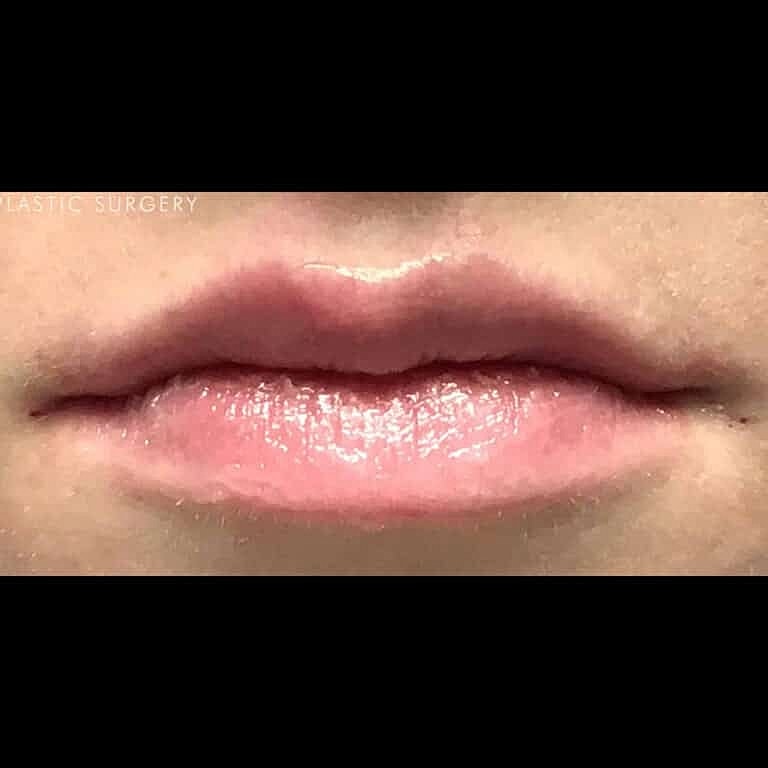 Restylane Before & After