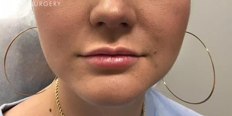 Restylane Before & After