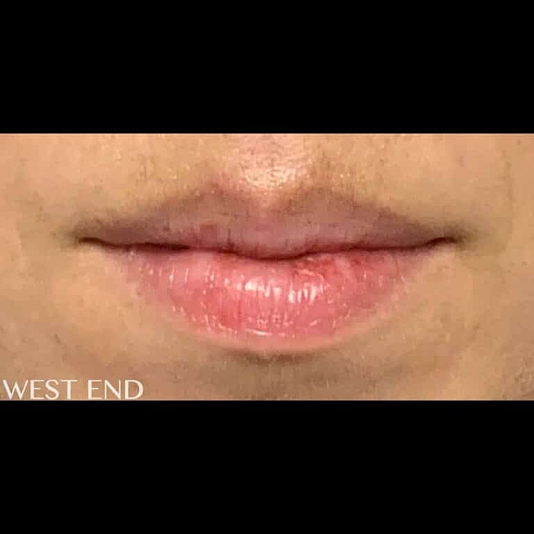 Restylane Before & After