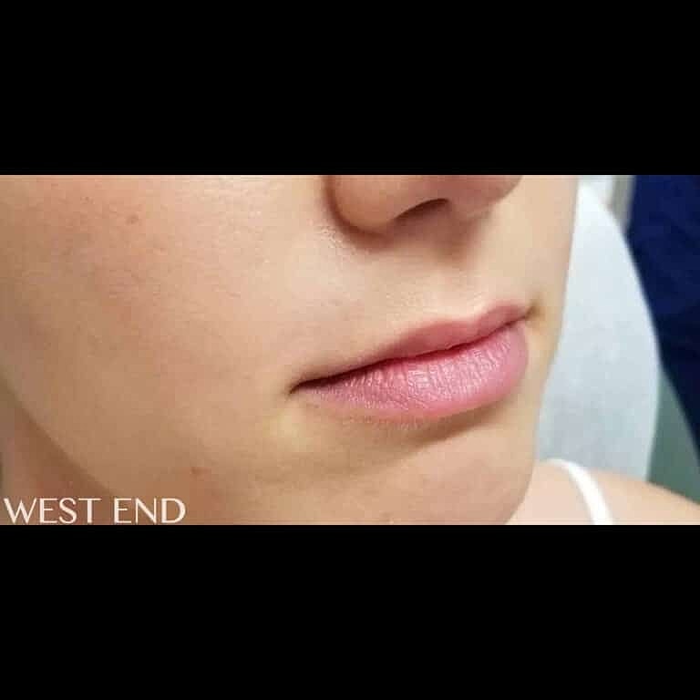 Restylane Before & After