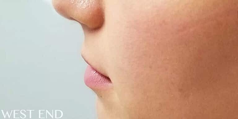 Restylane Before & After