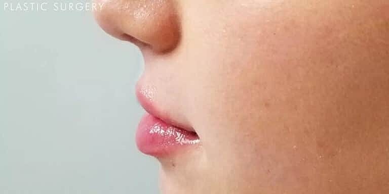 Restylane Before & After