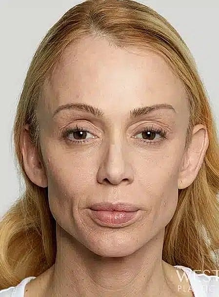 Sculptra Before & After