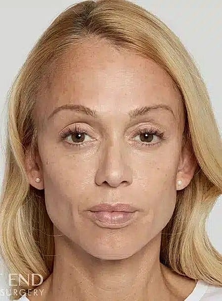 Sculptra Before & After