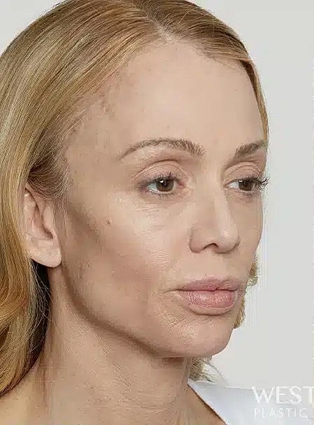 Sculptra Before & After